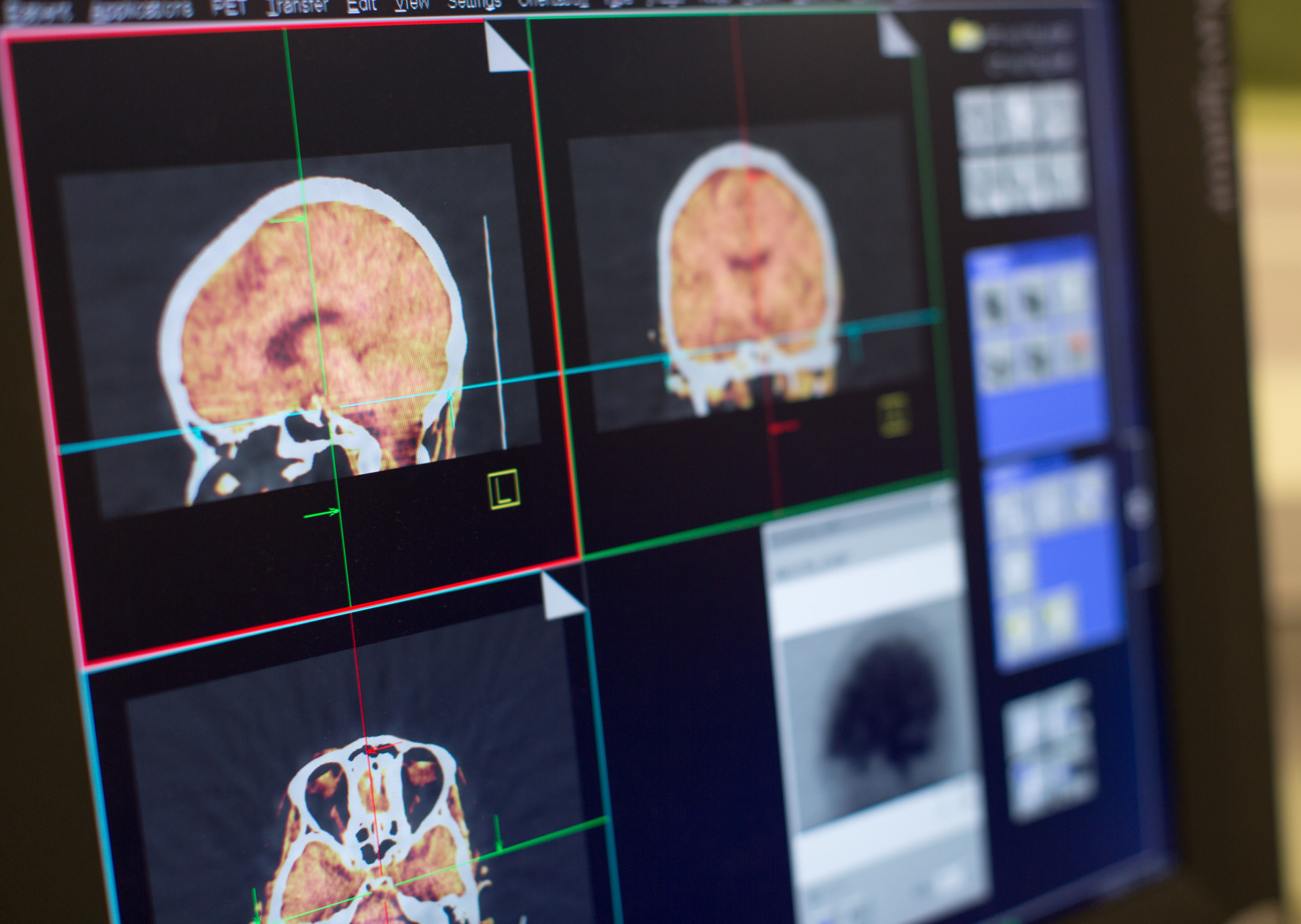 Psicadélicos no tratamento de perturbações psiquiátricas: evidência atual e desafios futuros